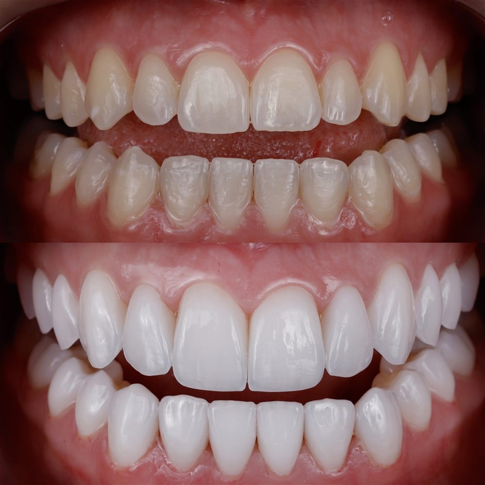 Antes e depois - caso 2